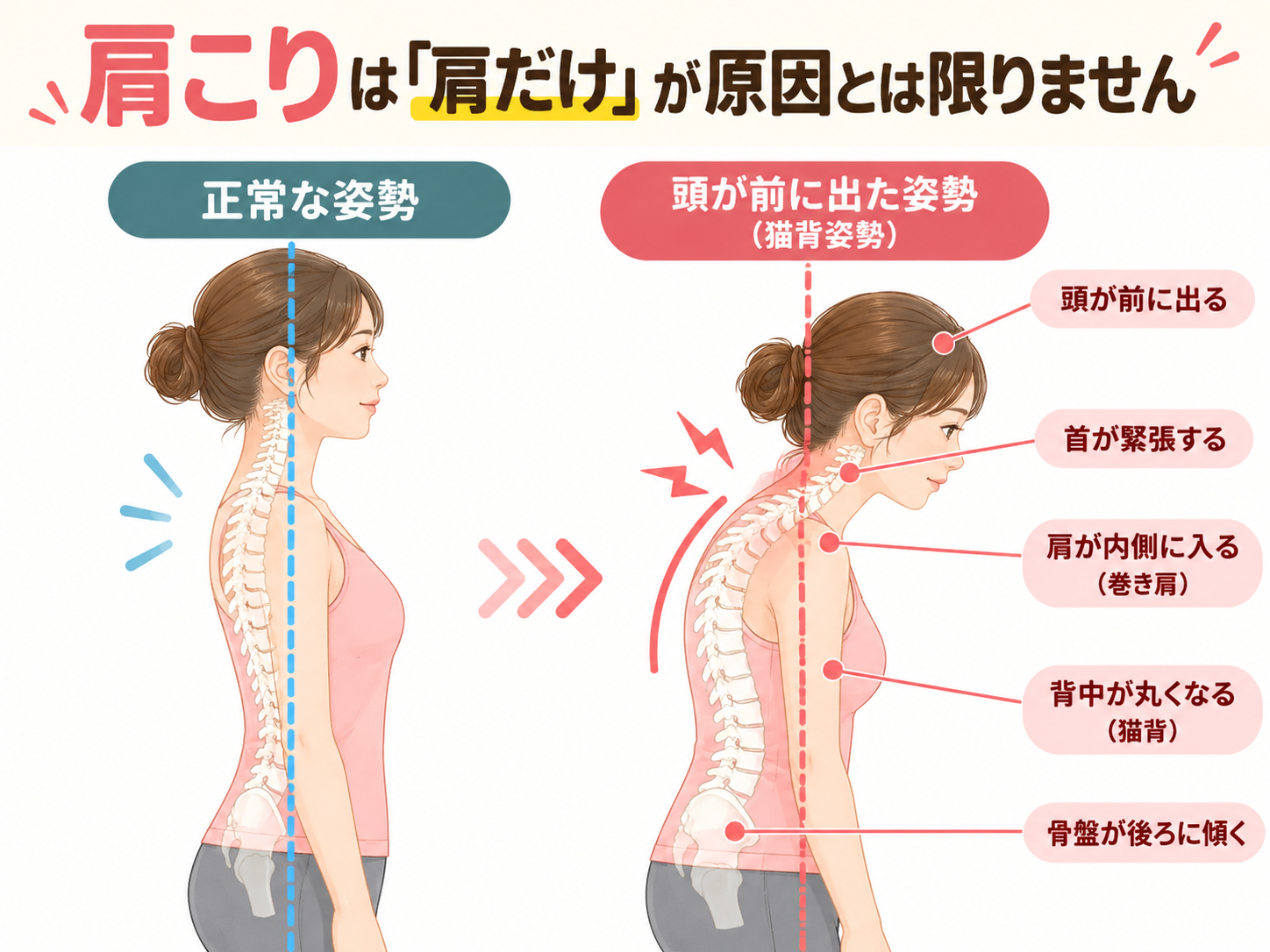 肩こりにつながりやすい姿勢の比較|八幡市
